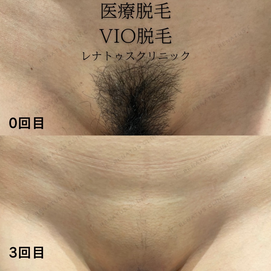 医療 VIO脱毛 0回目から3回目のビフォーアフター症例 富山・高岡